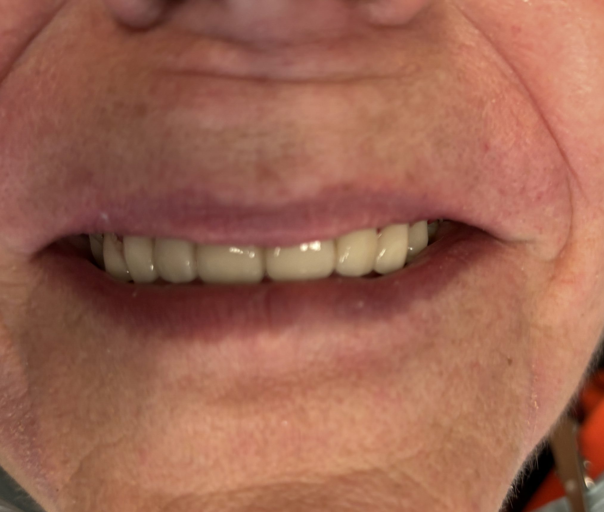 Straight and white teeth following a dental veneer procedure