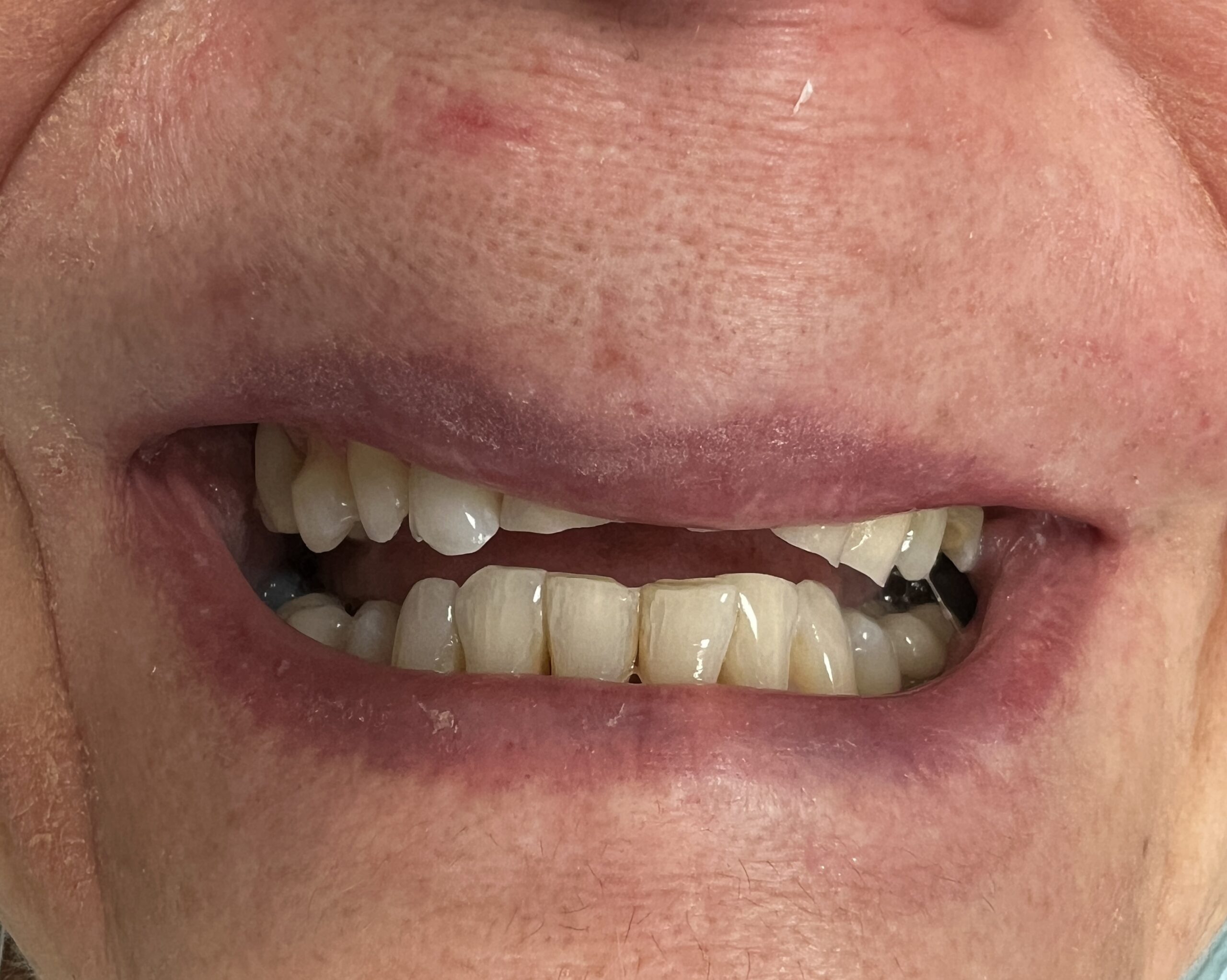 Decayed and crooked teeth of an older patient