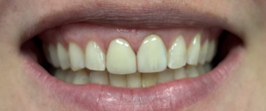 A close up of a patient with perfect teeth following a dental crown
