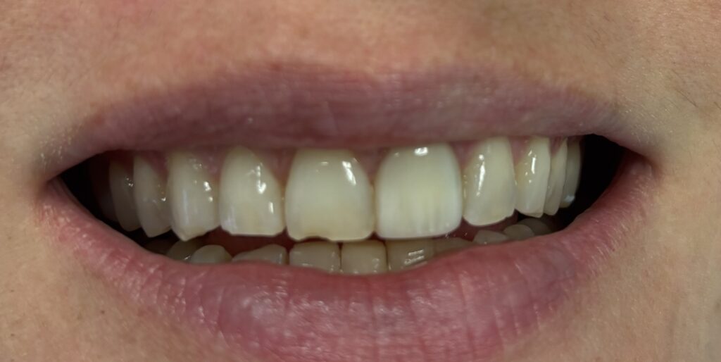 A close up of a patient with chipped front teeth