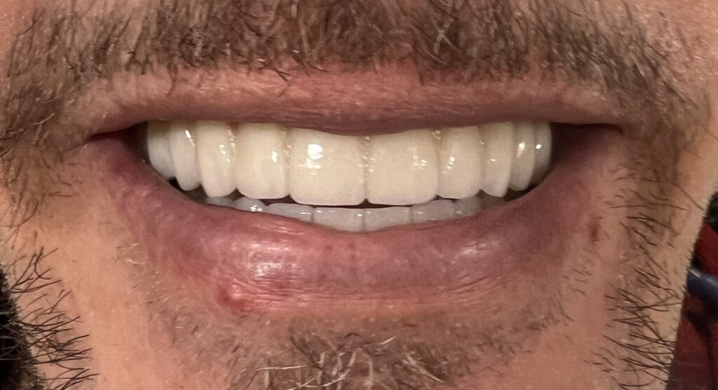 Clinical closeup of a patient with perfect teeth following a hybrid implant treatment