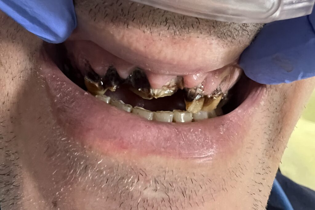 Clinical close up of severely damaged decayed teeth specifically the upper arch of teeth.
