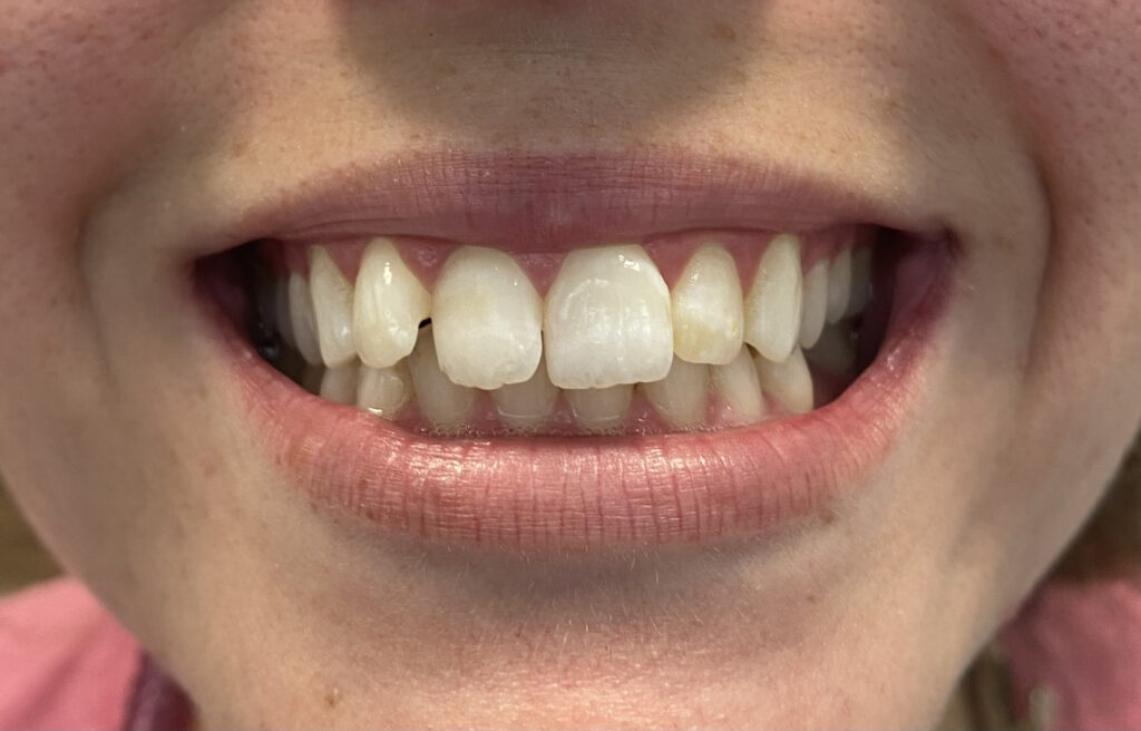 A patient with a overbite and crooked teeth with some gaps.
