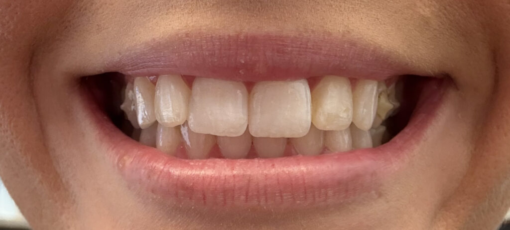 Clinical close up of straight teeth following an Invisalign treatment plan.