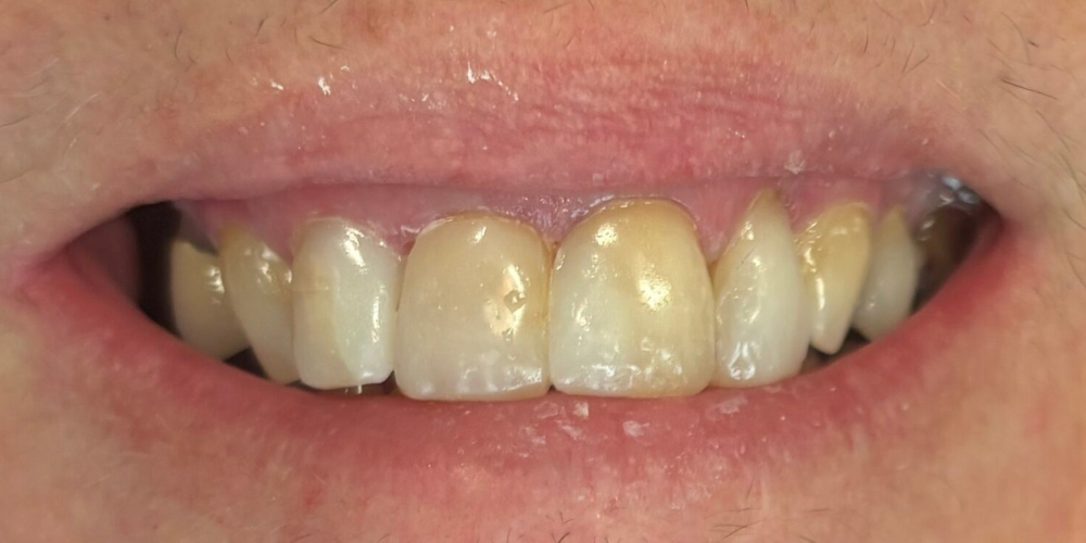 Close up shot of a mouth after dental bonding with white teeth