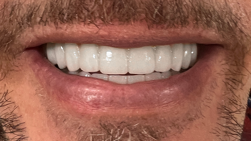 A perfect smile following hybrid dental implant treatment