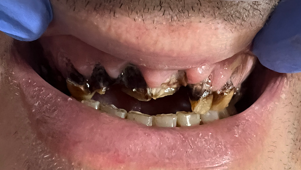 Severely decayed upper arch of teeth