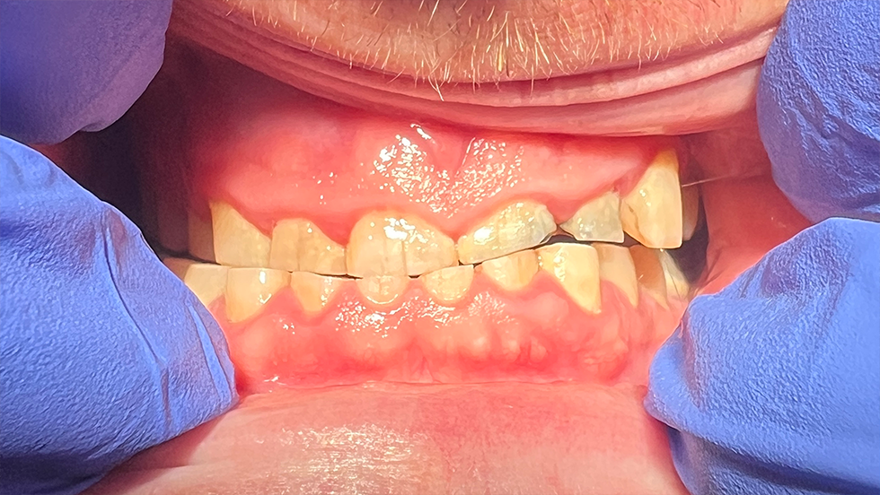 Clinical photo of severely flattened and damaged teeth
