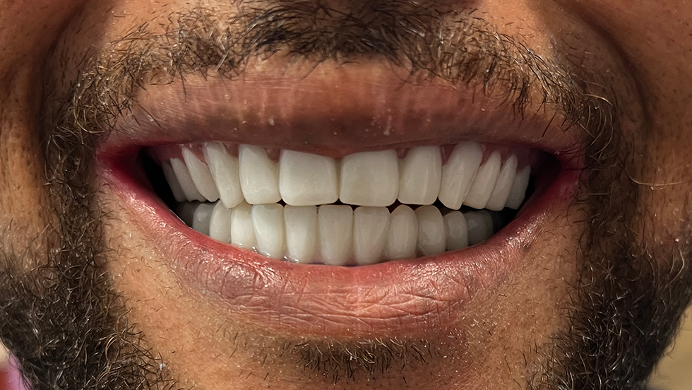 Close up of a white smile following snap in dental implant treatment