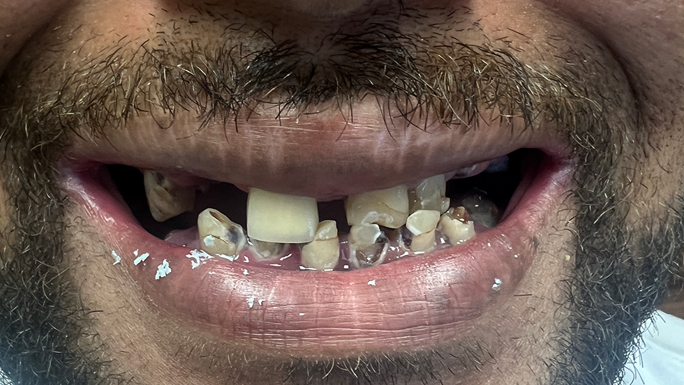 Close up of severely damaged and decayed teeth
