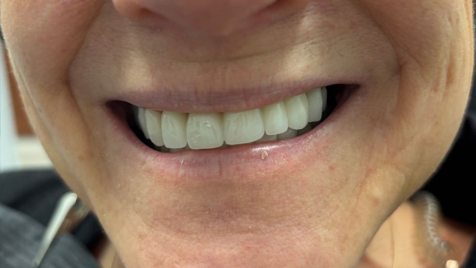 Veneers w bridge - The Buffalo Dentist - After