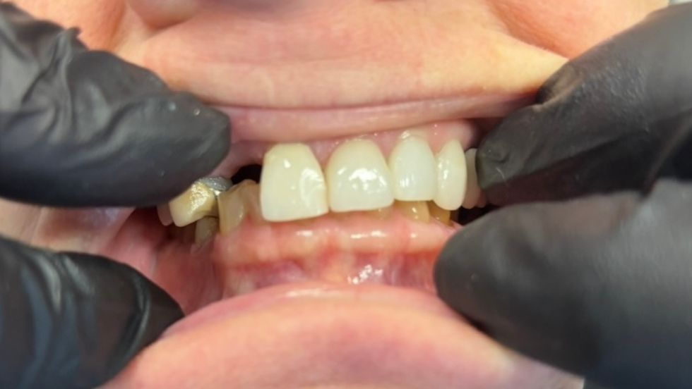 Veneers w bridge - The Buffalo Dentist - Before